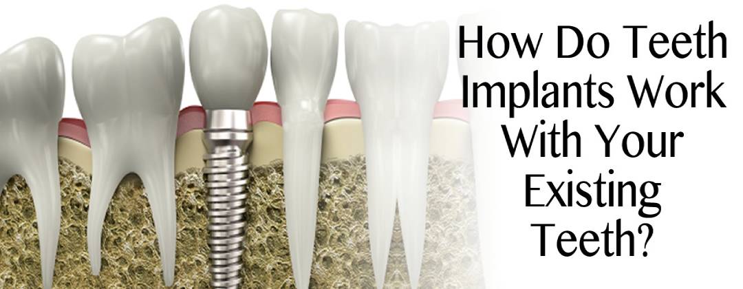 How Do Teeth Implants Work With Your Existing Teeth?