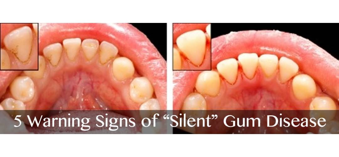 5 Warning Signs of “Silent” Gum Disease
