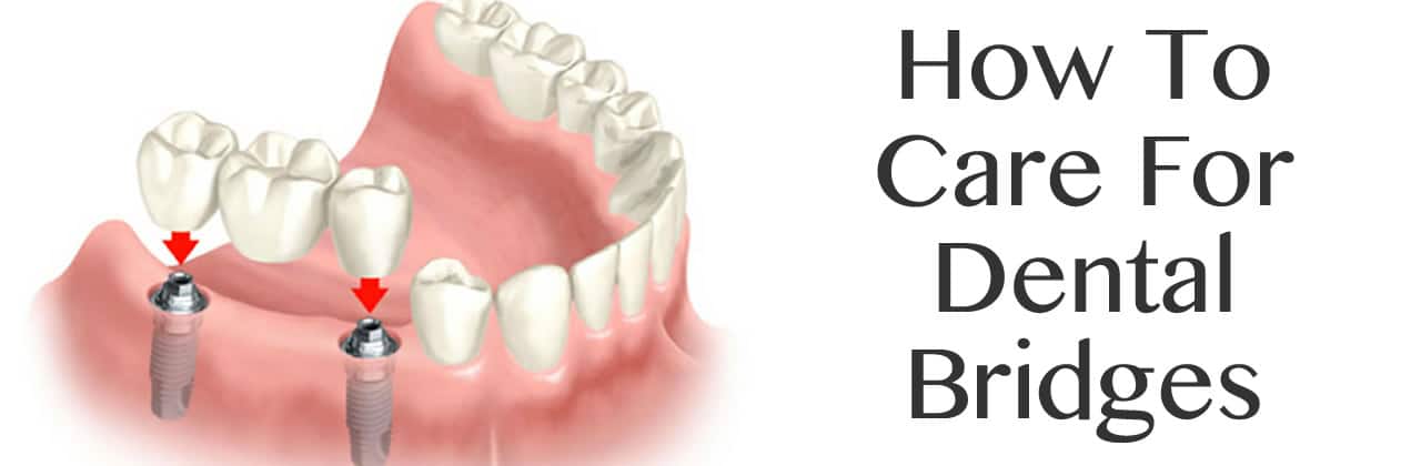 How To Care For Dental Bridges