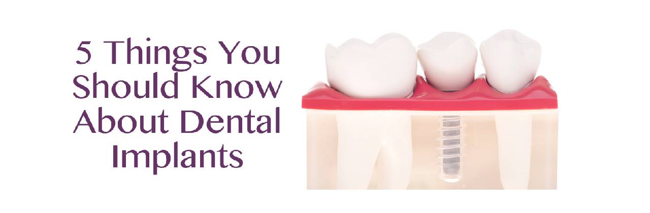 Things to Know About Dental Implants in Newton