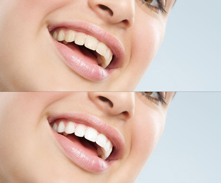 Teeth Whitening Newton MA