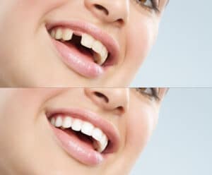 Dental Implants in Newton MA