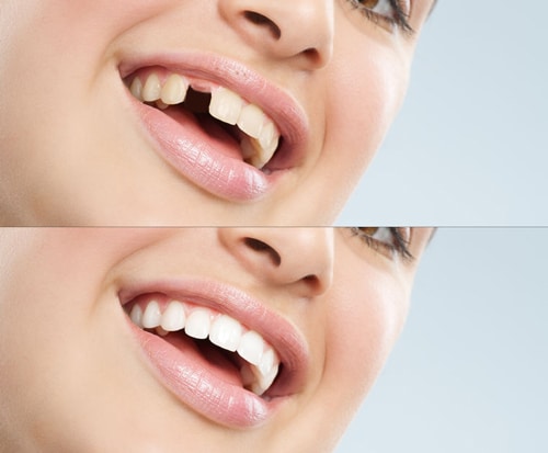 Dental Implants in Newton MA