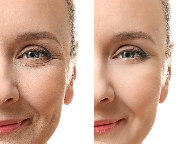 Botox Injections Therapy in Newtonville MA
