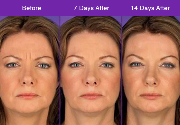 Botox Injections in Brighton MA