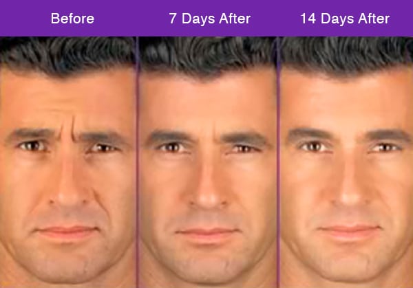 Botox Injections - Skin Works Medical Spa - Torrance, CA