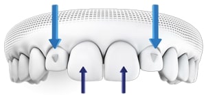 Invisalign