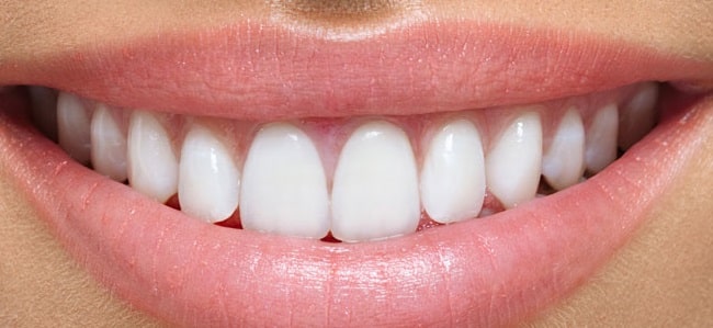 Porcelain Veneers Brighton MA