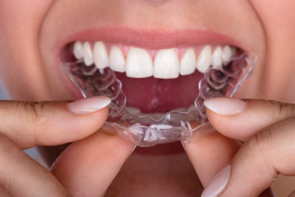 Close up shot of woman putting on mouth guard