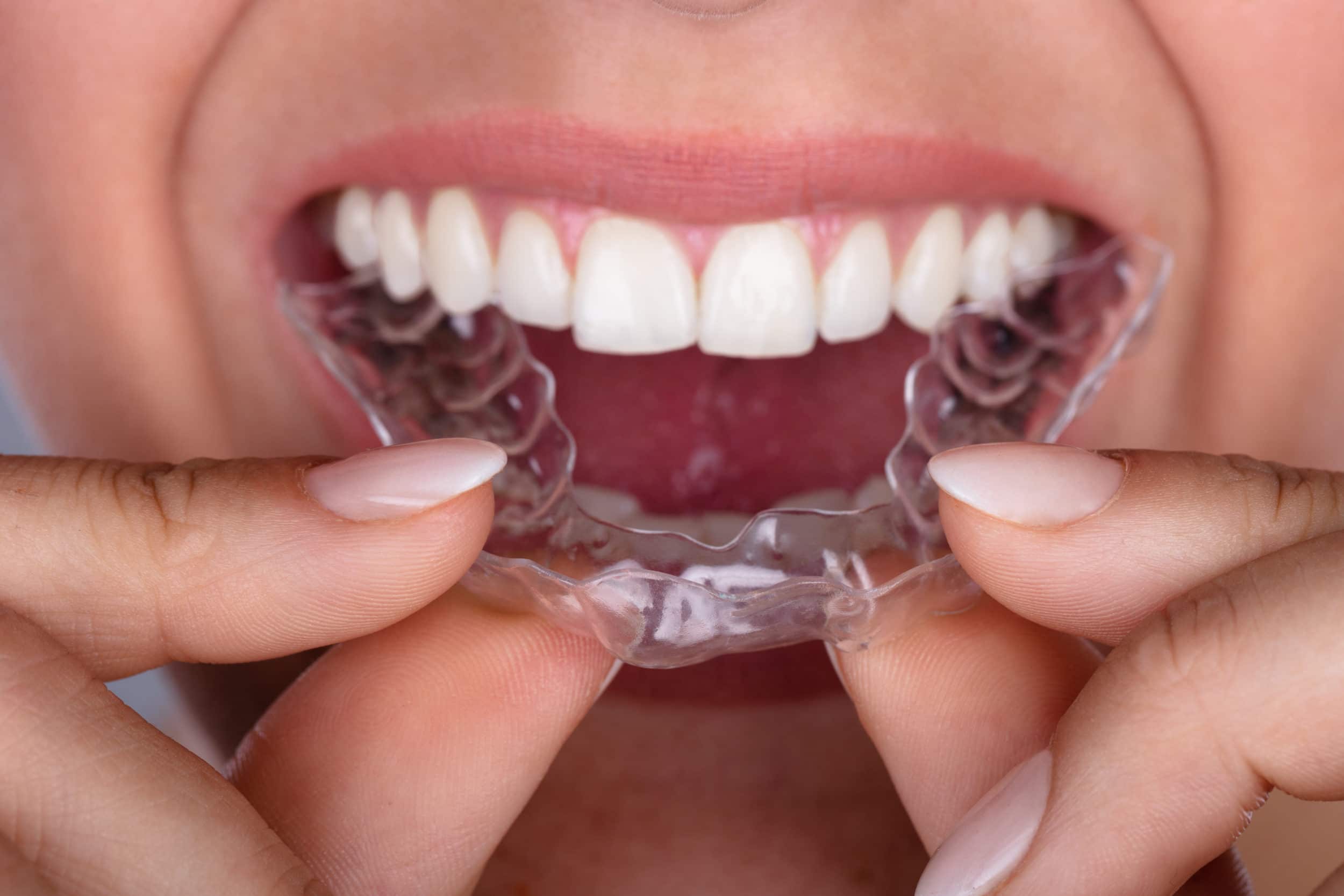 Teeth Grinding Treatment in Brighton MA