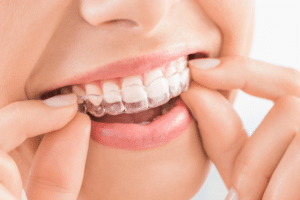 invisalign