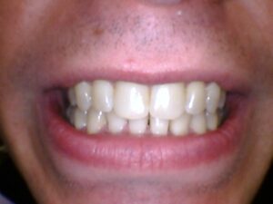 After Image: Invisalign