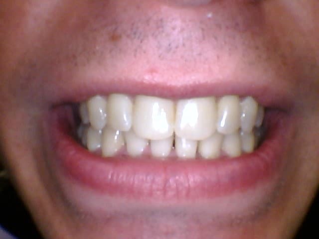 After Image: Invisalign - front
