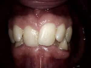 Before Image: Invisalign