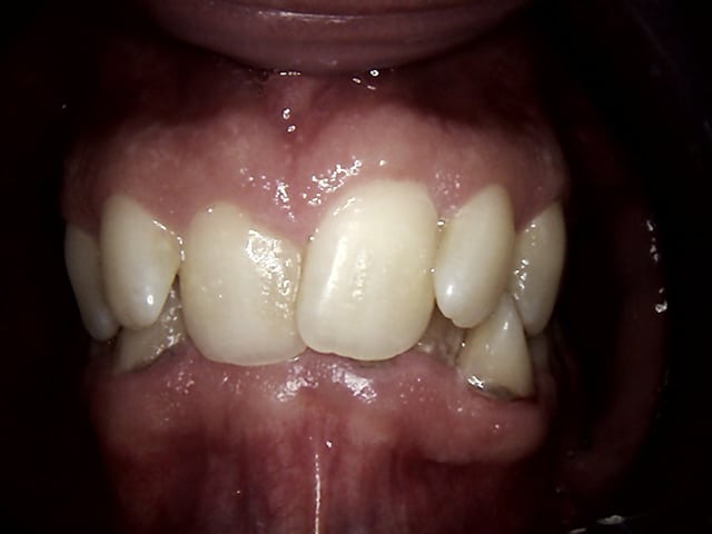 Before Image: Invisalign - front