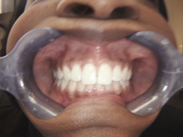 After Image: Invisalign - front