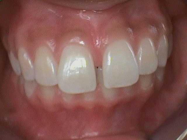 Before Image: Invisalign - front