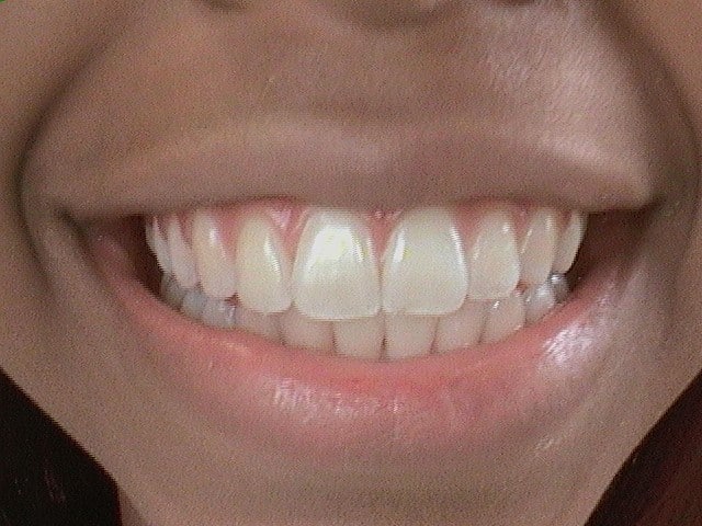 After Image: Invisalign - front