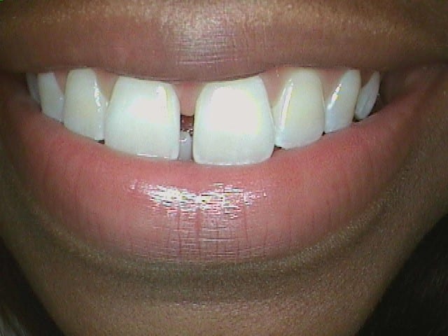 Before Image: Invisalign - front