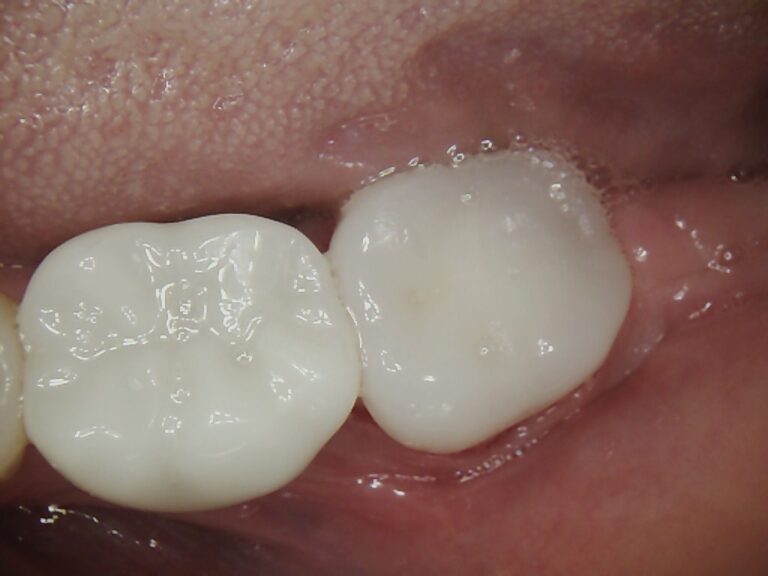 After Image: Broken Crown Repair - front