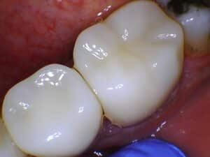 After Image: Crowns & Bridges