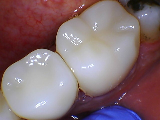 After Image: Crowns & Bridges - front