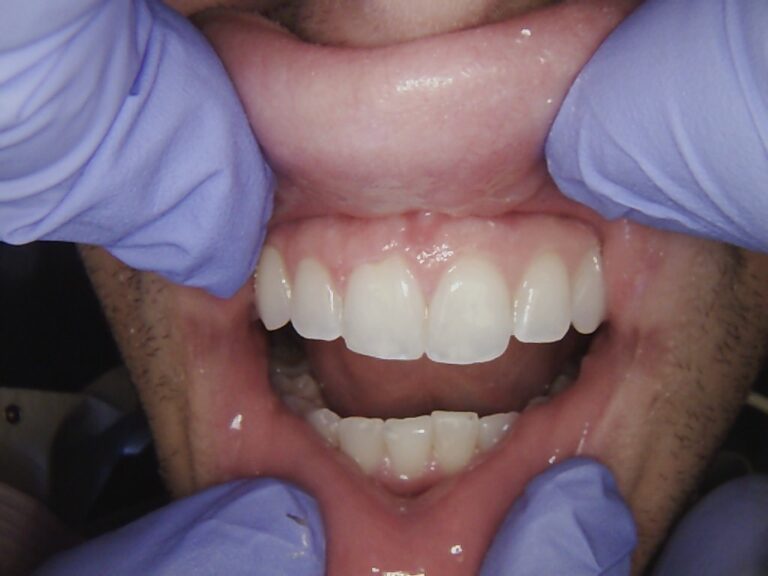After Image: Chipped Front Tooth - front