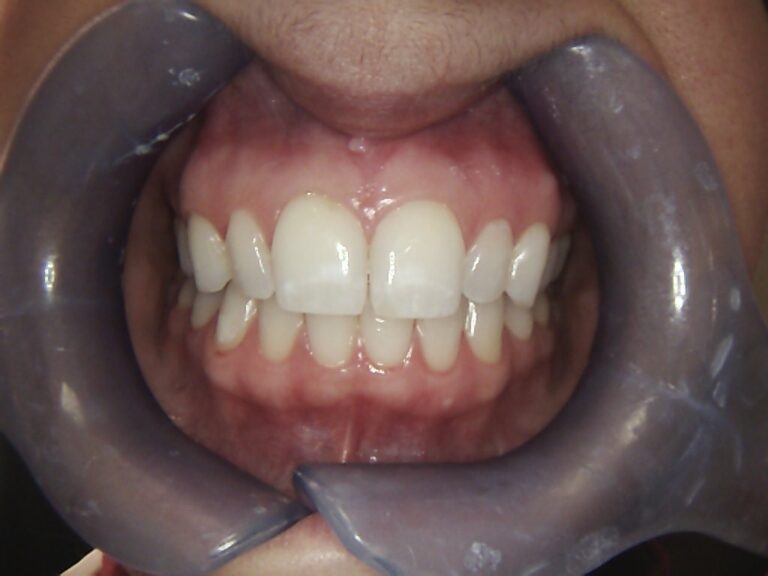 After Image: Invisalign - front