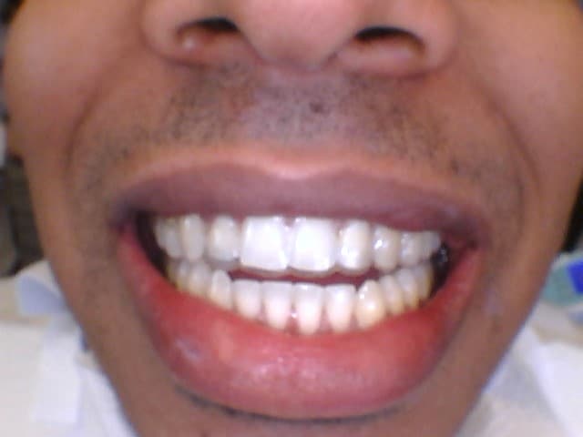 After Image: Invisalign - front
