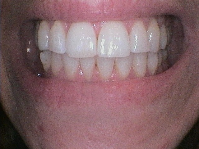 After Image: White FIllings - front