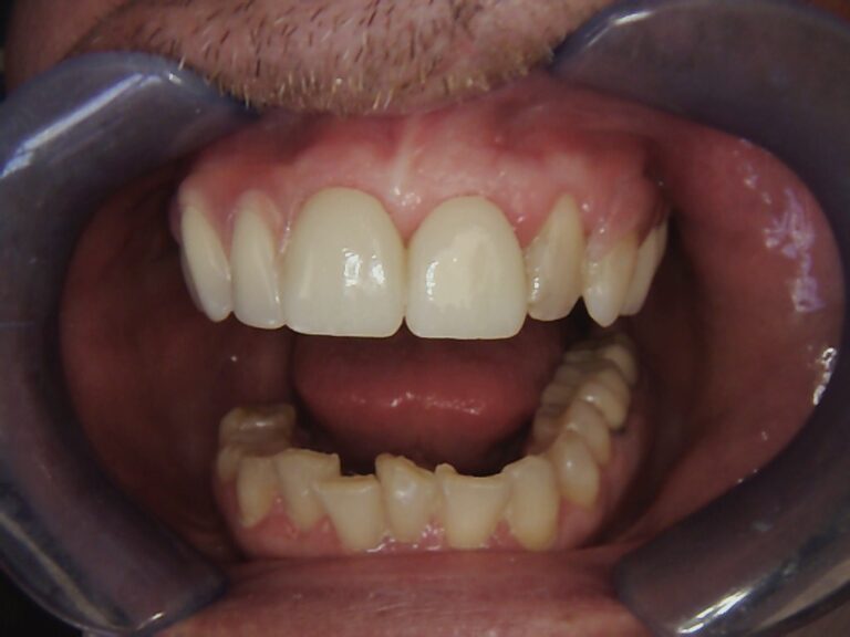 After Image: Multiple Wireless Partials -