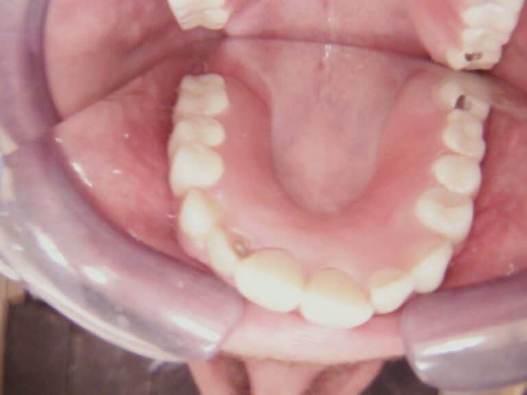 After Image: Multiple Wireless Partials - front