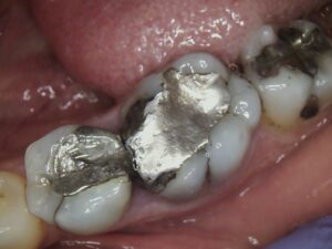 Before Image: Crowns & Bridges
