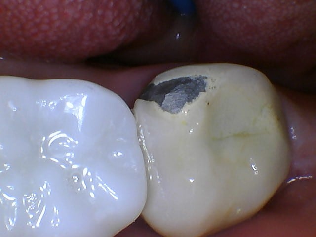 Before Image: Broken Crown Repair - front