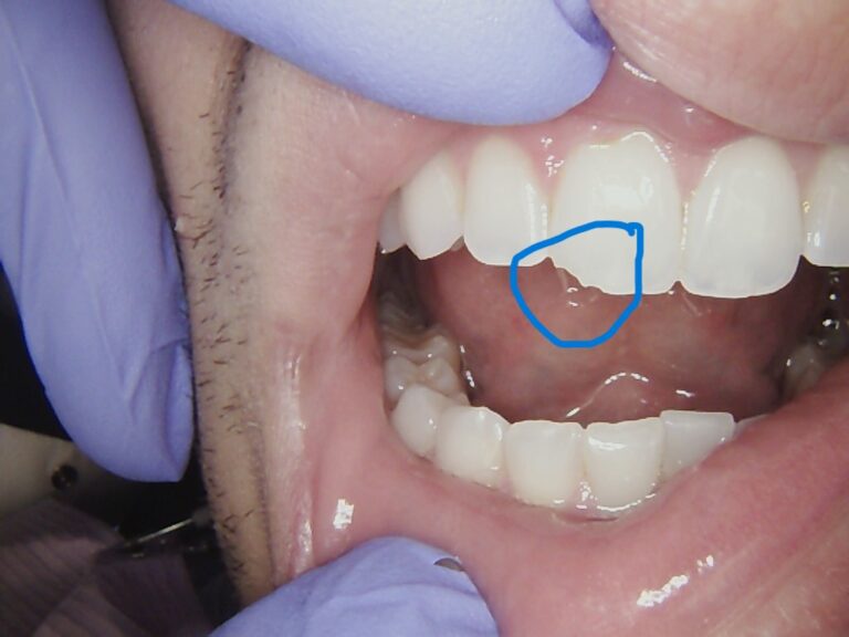 Before Image: Chipped Front Tooth - front