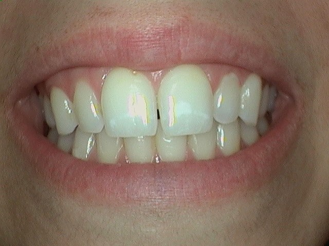 Before Image: Invisalign - front