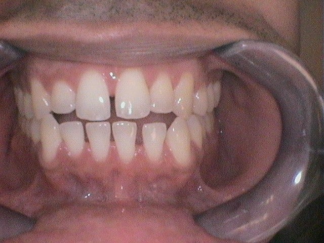 Before Image: Invisalign - front