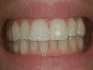 Before Image: White FIllings