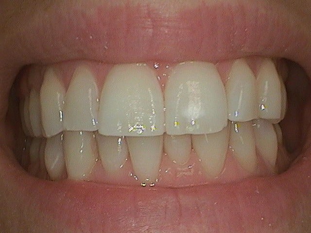 Before Image: White FIllings - front