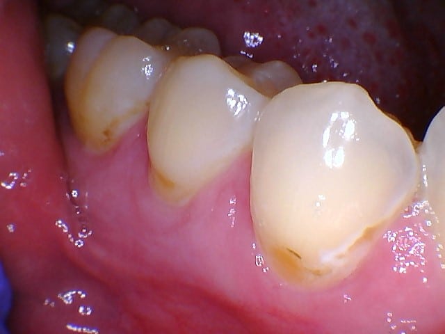 Before Image: Bonding - front