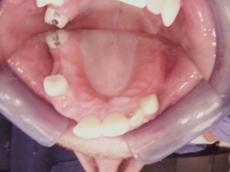 Before Image: Multiple Wireless Partials - front