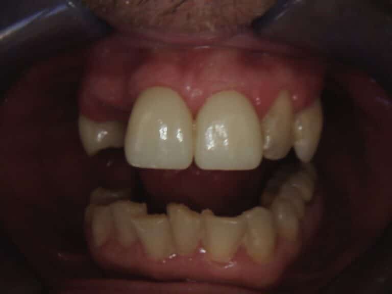 Before Image: Multiple Wireless Partials -