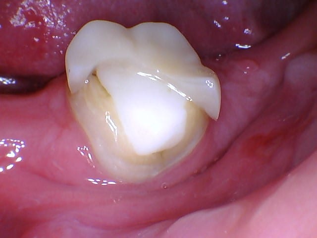 Before Image: Broken Crown Repair - front