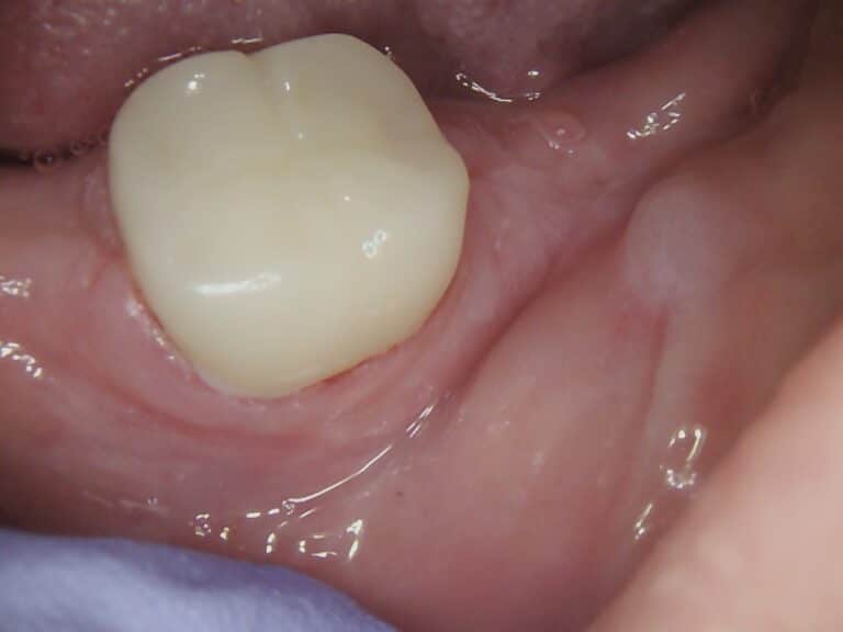 After Image: Broken Crown Repair - front