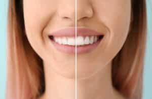 Before and after of girl who had gum recontouring with laser dentistry