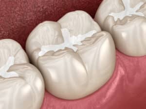 Close-up image of molars with white, tooth-colored composite filling