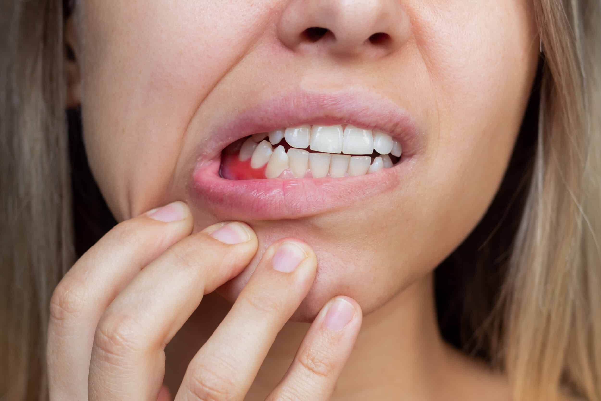 Woman pulling down her lower lip to expose red gums that may bleed