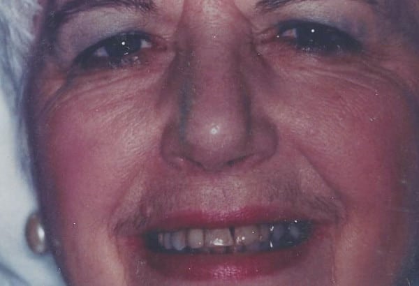 Before Image: Full Mouth Reconstruction - front