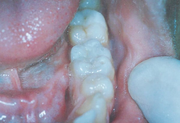 After Image: White FIllings - other