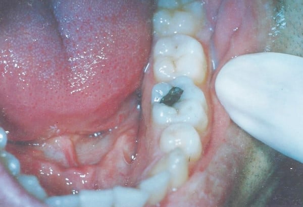 Before Image: White FIllings - other